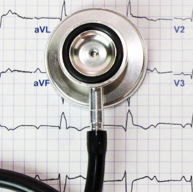 Does Atrial Fibrillation Show on An ECG Monitor