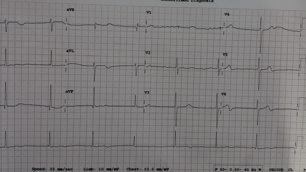 AFib Complications: All You Need To Know About AFib Complications