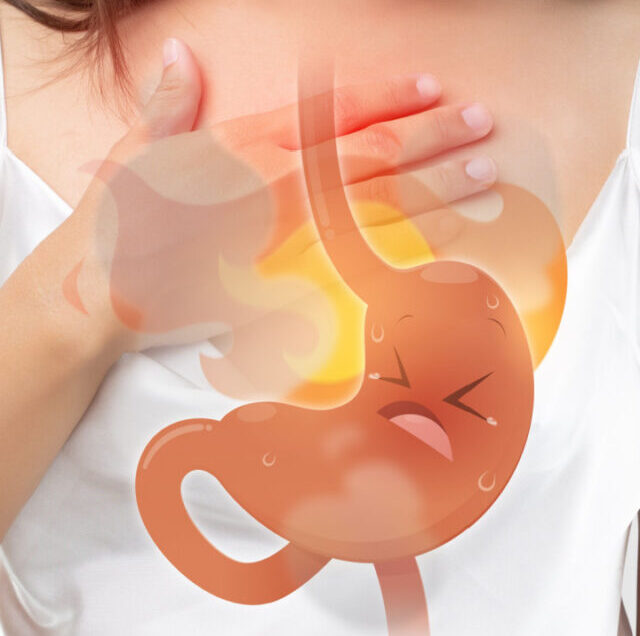 acid reflex