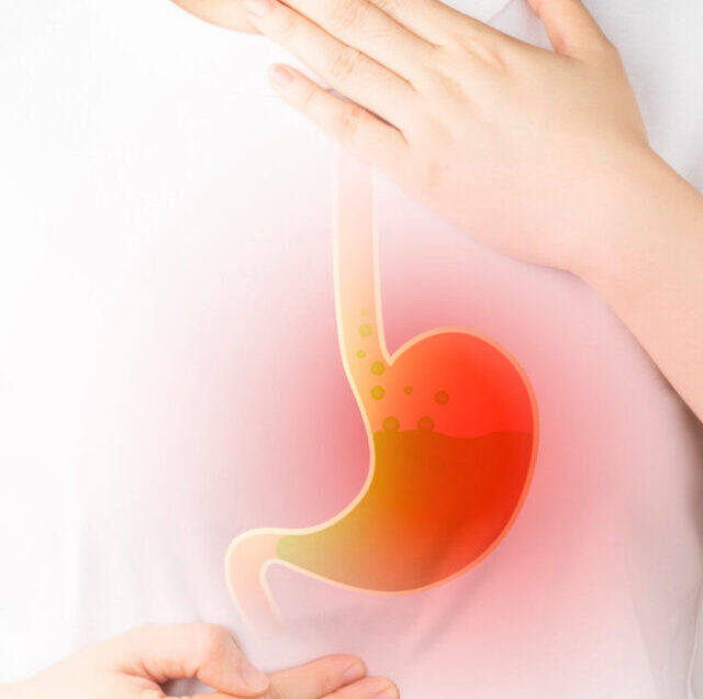 Gastroesophageal,Reflux,Disease,(gerd),Or,Acid,Reflux,Symptoms.,Woman,Suffering