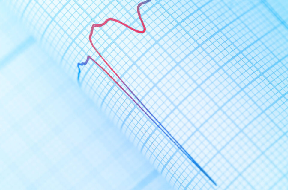 Arrhythmias Explained: Types, Causes, and Symptoms
