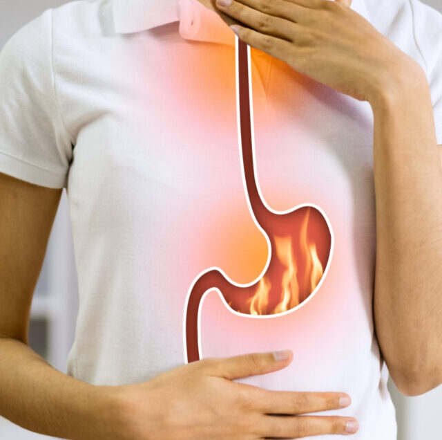Acid Reflux (2)